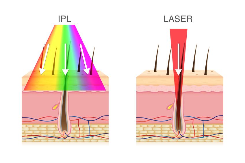 Laser-Haarentfernung vs. IPL-Haarentfernung